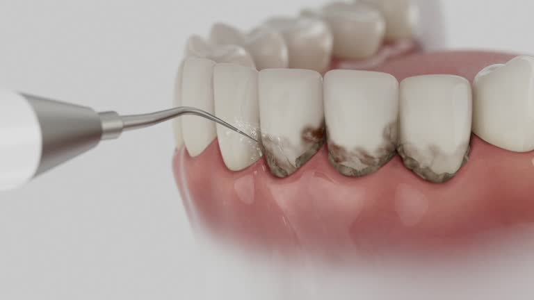 Trusted Dental Crowns And Bridges service in Wild Peach Village, TX - Dentist Open Now